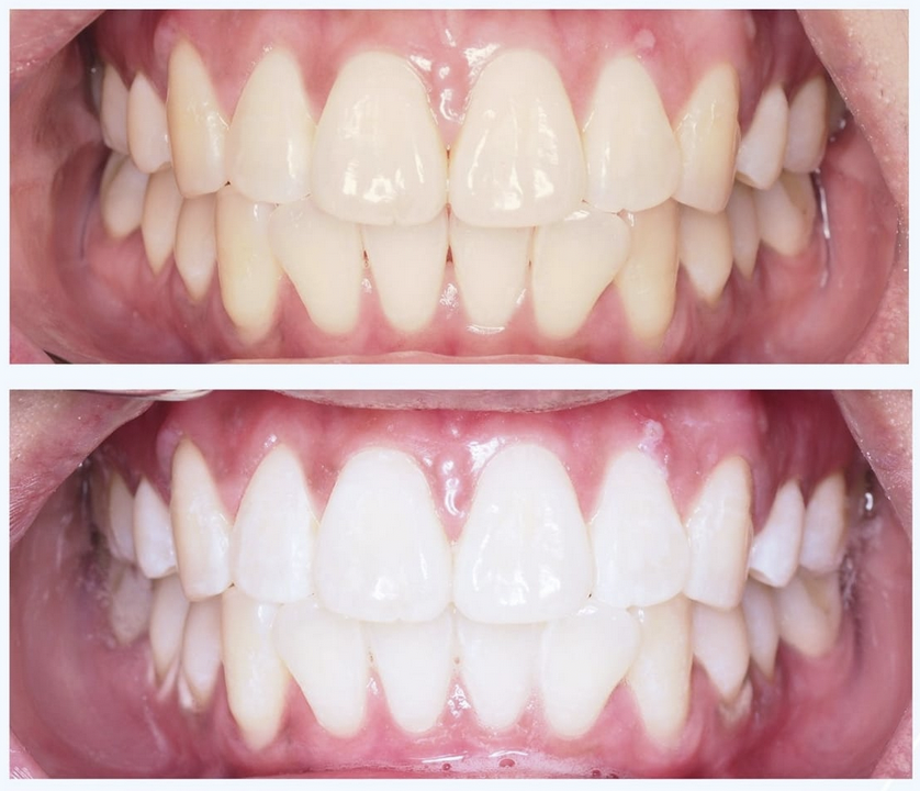 teeth whitening, whitening, cosmetic dentist, dental clinic, huahin dentist, recommended dentist, floss dentil clinic